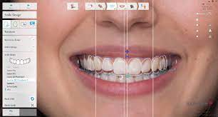 Digital Smile Designing with zirconia teeth, India