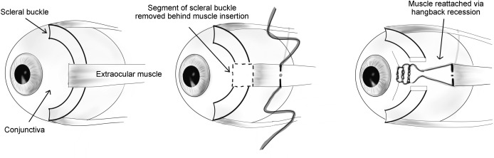 VITREO RETINAL PROCEDURES Buckle Removal Single Eye