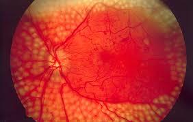 Retinal Laser Per Sitting PPR Laser Single Eye