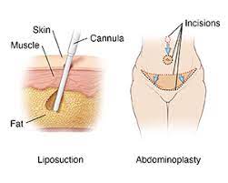 Abdominoplasty With Liposuction
