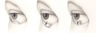 ORBIT AND OCULOPLASTY Ectropion Surgery Single Eye