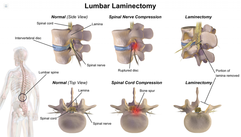 Spine Cervical or Thoracic or Lumbar Laminectomy