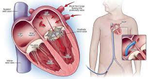 Double Valve Replacement and CABG, United Arab Emirates