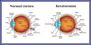 CORNEAL AND OCULAR SURFACE PROCEDURES-C3R (UV radiation Crosslinking- for keratoconus) - Single Eye