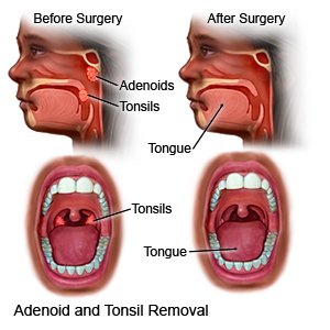 Adenoidectomy, India