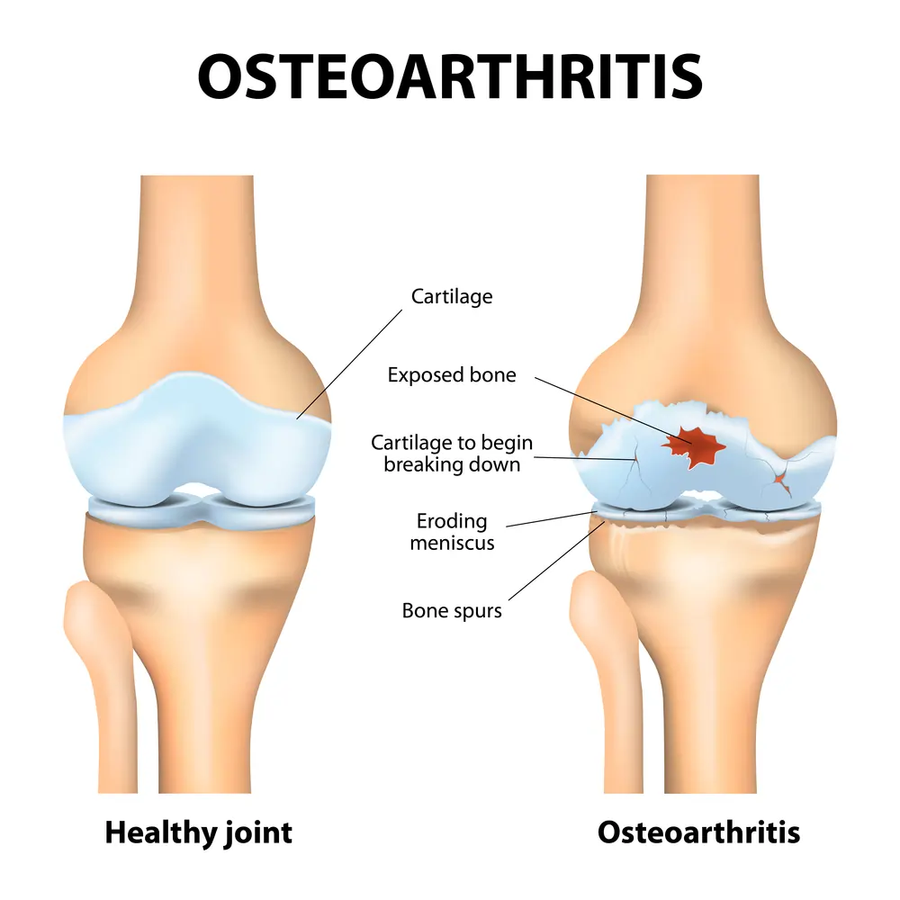 Ayurveda Treatment for Knee Pain (Osteoarthritis)