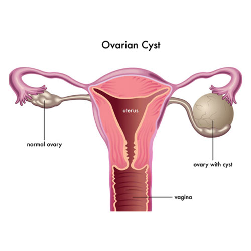Ovarian Cyst Removal