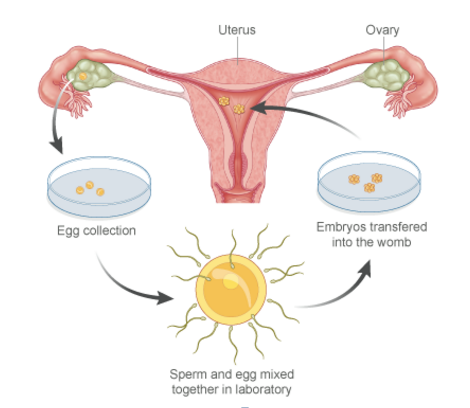 IVF - 1 cycle own egg and sperm+ ICSI including Injections