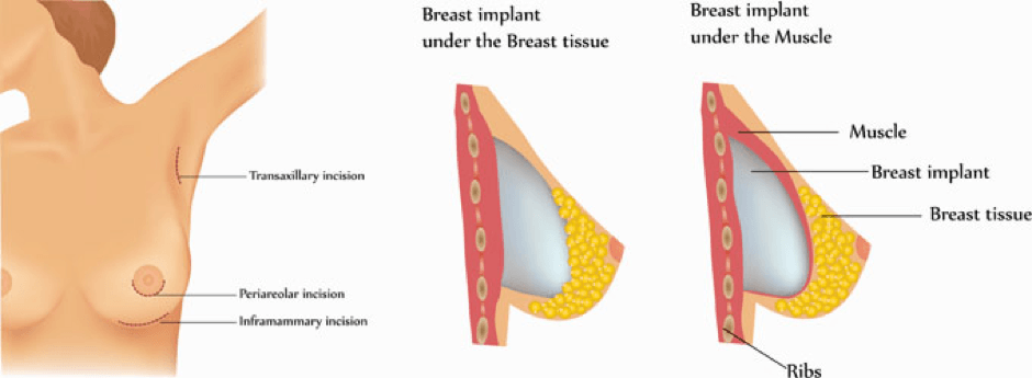 Breast Augmentation/Mammoplasty, Thailand