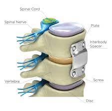 Spine Cervical Discectomy