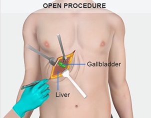 Open - Cholecystectomy