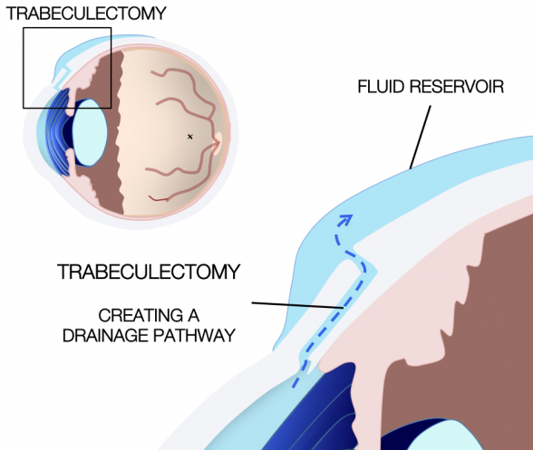 GLAUCOMA PROCEDURES Trabeculotomy Single Eye