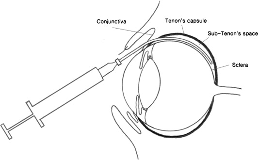 CORNEAL AND OCULAR SURFACE PROCEDURES-Subtenon's / Subconjuctival Injection, India