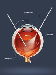 CATARACT Secendory IOL and Anterior Viterectomy Single Eye