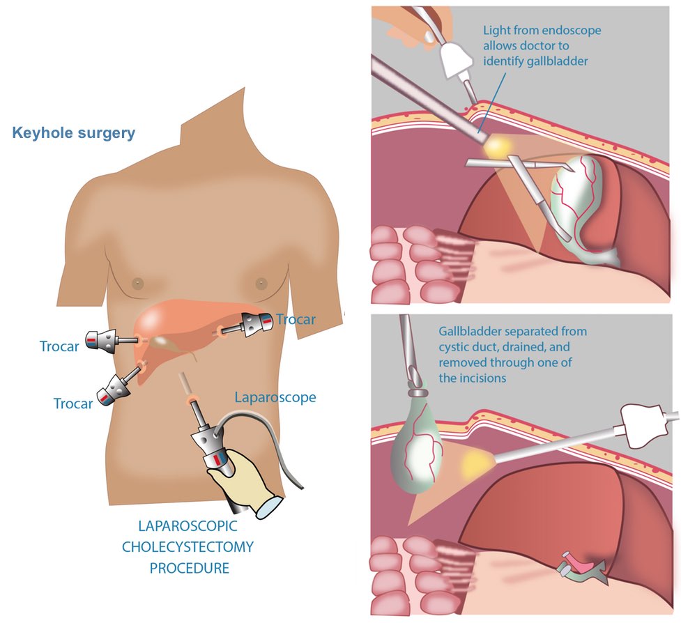 Lap Cholecystectomy, Singapore