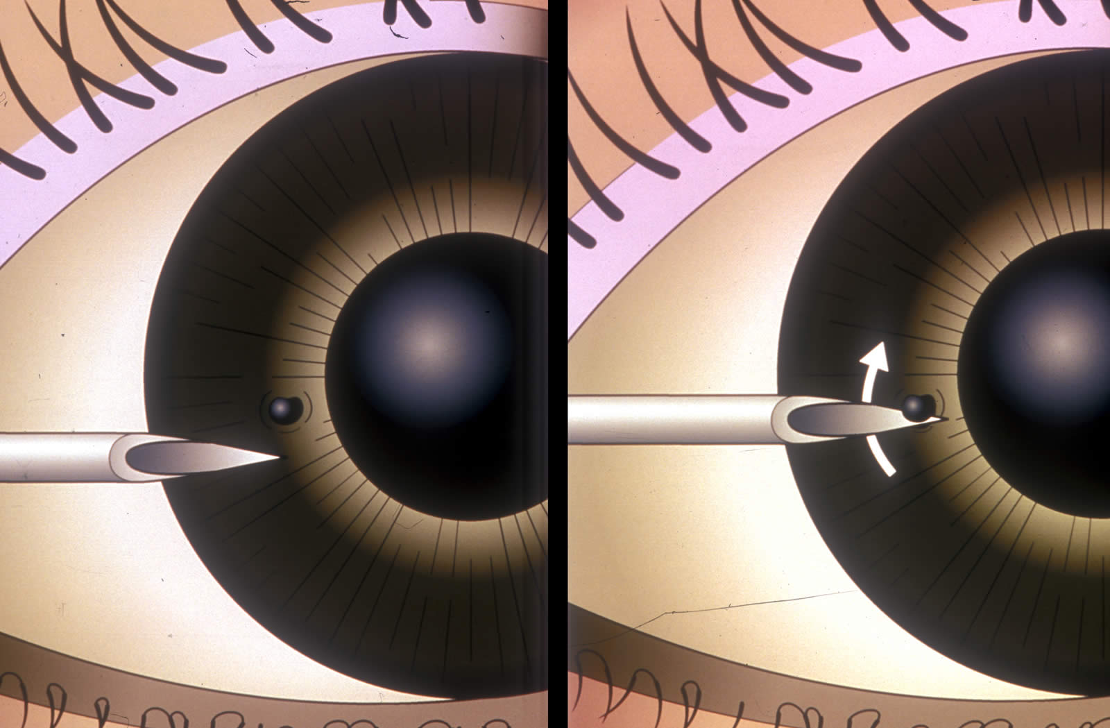 CORNEAL AND OCULAR SURFACE PROCEDURES - Corneal foreign body removal -Single Eye