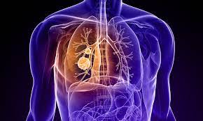 Lung cancer surgery