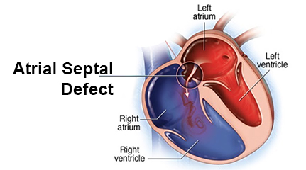 Atrial Septal Defect (ASD) Repair, India