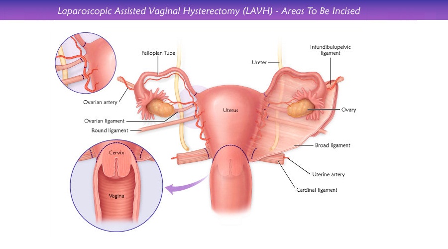 Laparoscopic Vaginal Hysterectomy