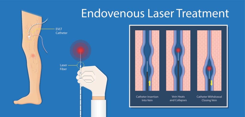 Endo-Vascular Laser Therapy EVLT BL