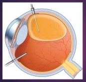 VITREO-RETINAL PROCEDURES-Silicon Oil Removal - 23G, Sature Less - Single Eye