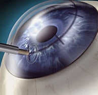 CORNEAL AND OCULAR SURFACE PROCEDURES-Astigmatic Keratotomy- Single Eye