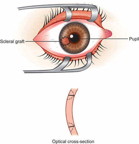 CORNEAL AND OCULAR SURFACE PROCEDURES-Scleral graft for scleral melting/perforation