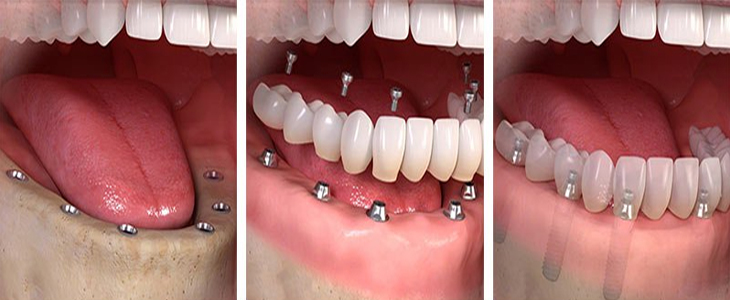Full Mouth Implant for Lower Jaw 8 implants and 14 units Metal free bridge Zirconia: