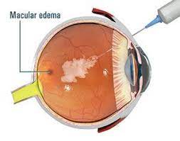 VITREO RETINAL PROCEDURES Intravitreal Injection Tricort Single Eye