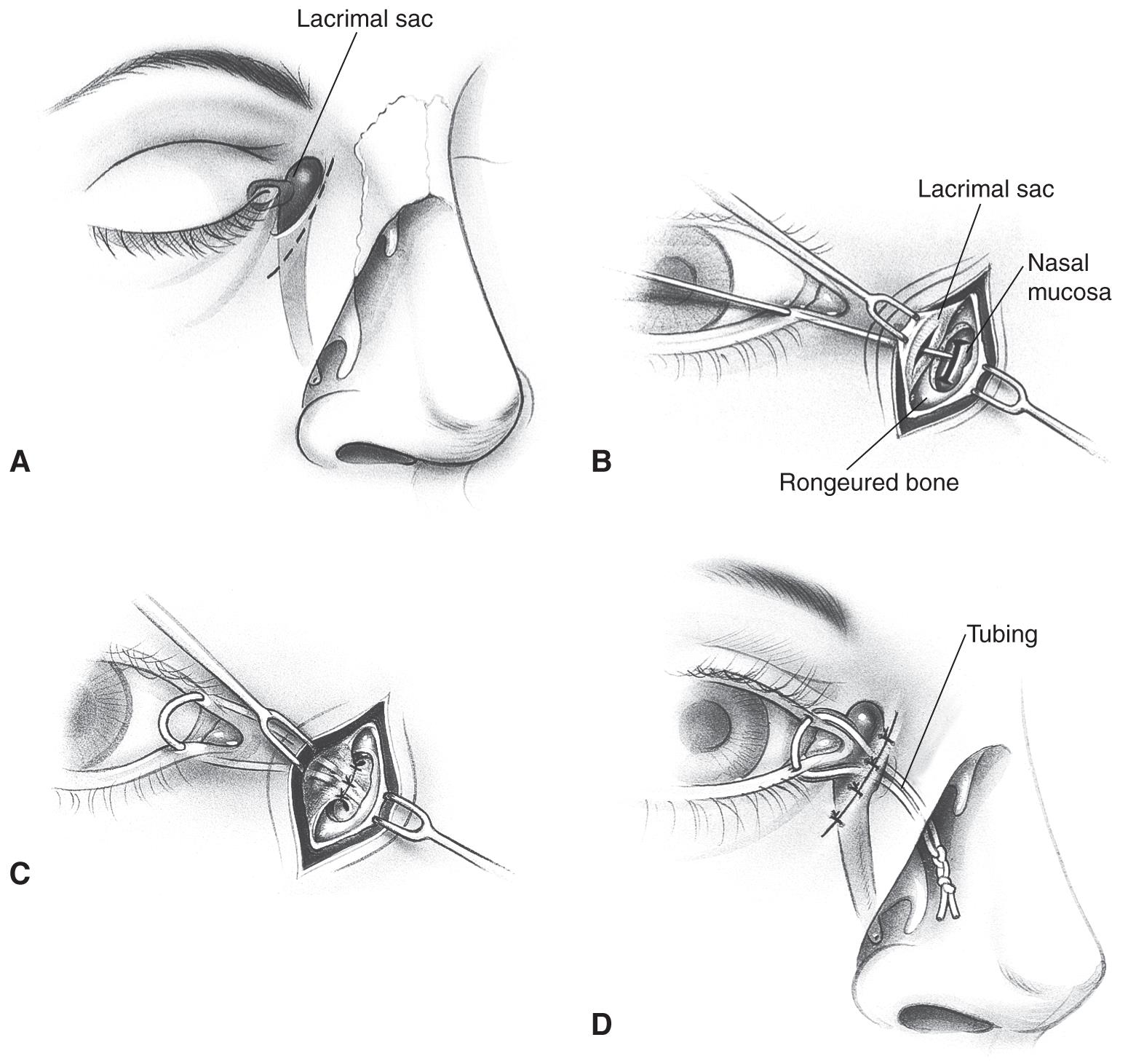 ORBIT AND OCULOPLASTY DCR with Intubation Single Eye