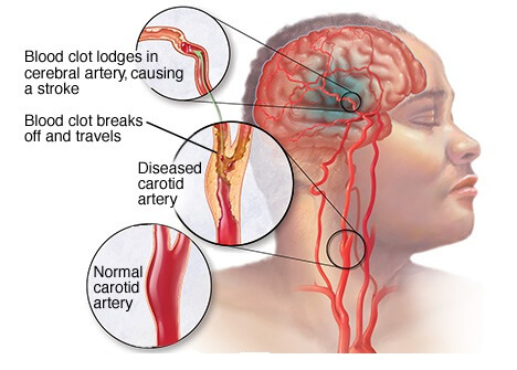 Brain Hemorrhage or Intracerebral Hemorrhage Surgery