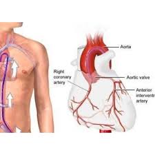 Coronary Angiogram