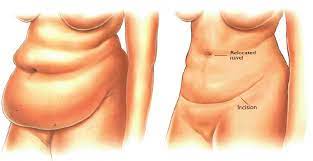 Abdominoplasty (Tummy Tuck), India