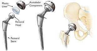 Revision Hip Replacement, Thailand