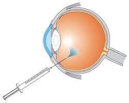 VITREO RETINAL PROCEDURES Intravitreal Ozurdex Implant Single Eye