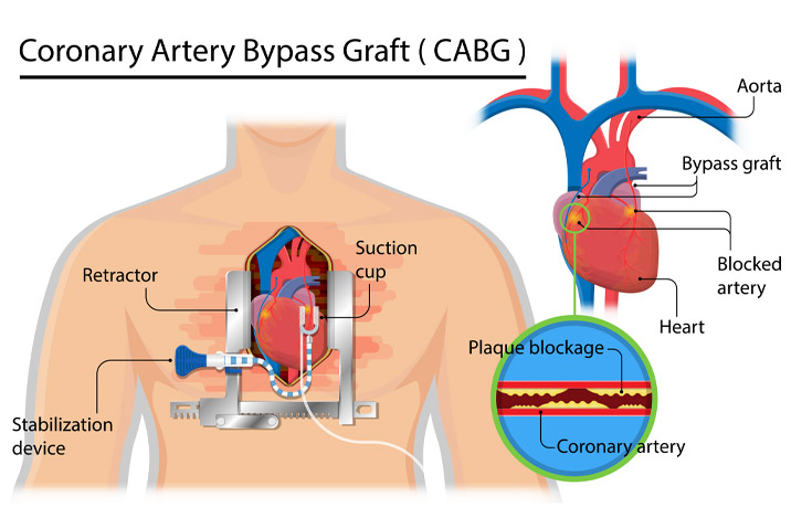 Heart Bypass - Minimally Invasive CABG, Turkey