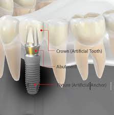 Conventional Implants - Dentium