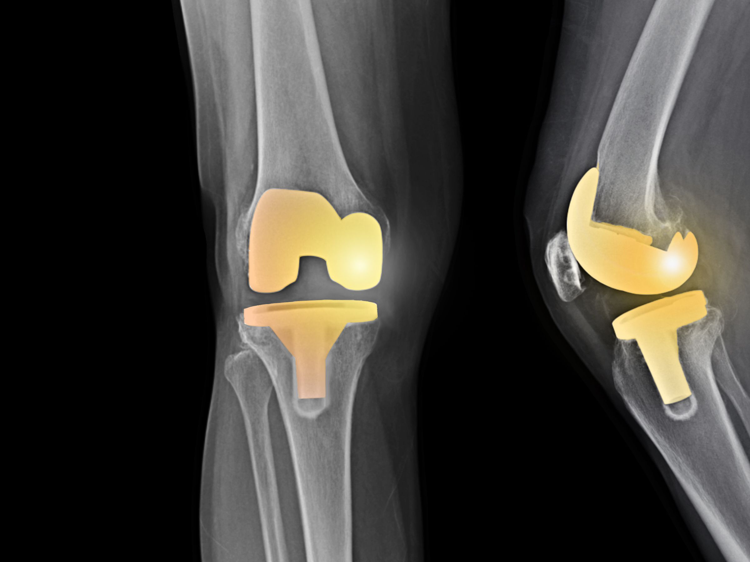 Total Knee Replacement UL, India