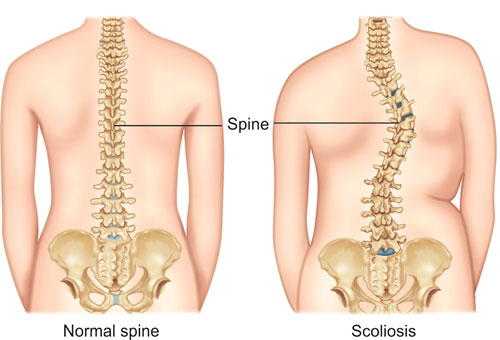 Scoliosis Hemiepiphysiodesis Spine