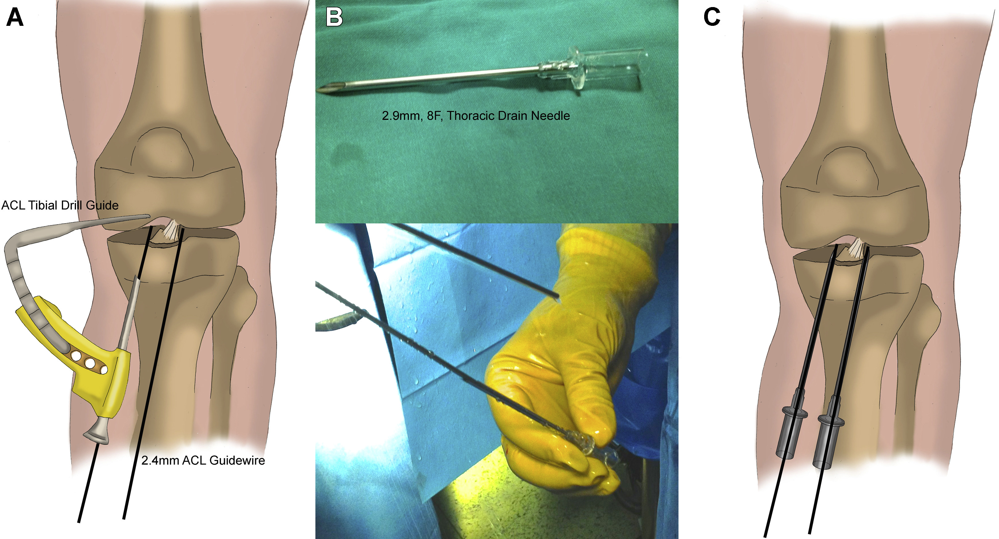 ACL or PCL Avulsion Fixation Arthroscopic Open Surgery