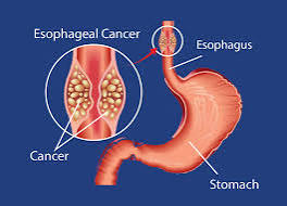 Esophagus Cancer Treatment