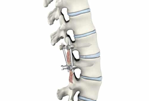 Lumbar Posterior Spinal Fusion Surgery