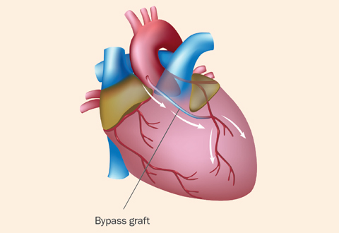 CABG