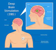 Deep Brain Stimulation - Rechargeable Implant, Singapore