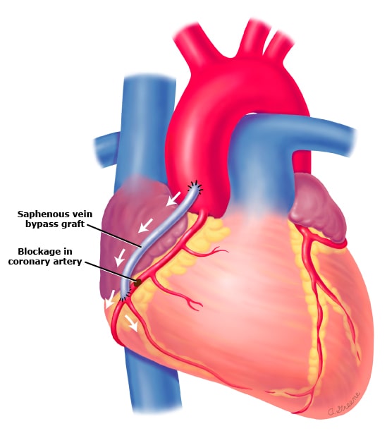 CABG