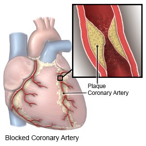 Coronary Artery Surgery, Turkey
