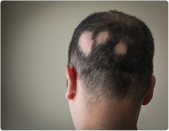 Ayurveda Treatment for Alopecia, India