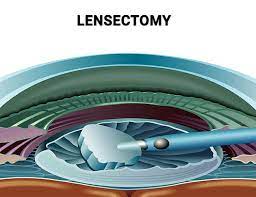 Lensectomy, Iran