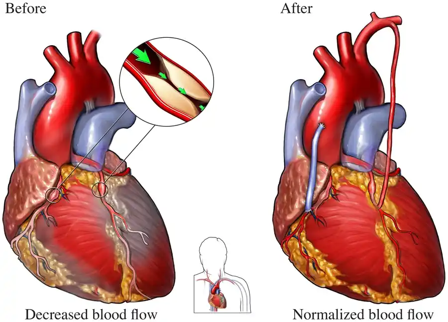 CABG