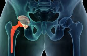 Total Hip Replacement UL